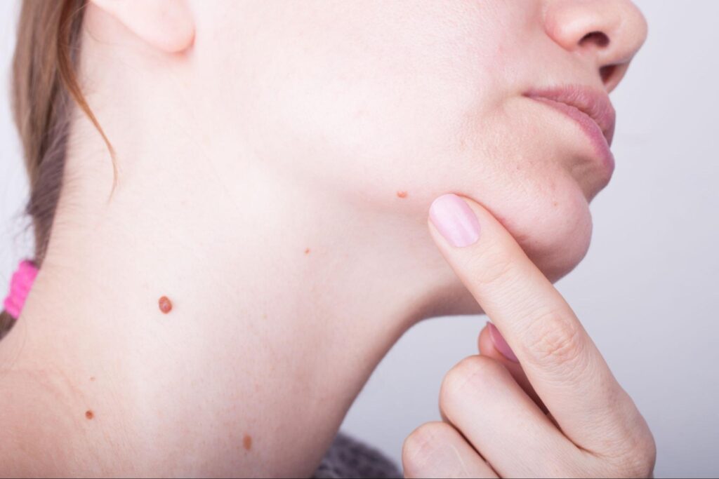 イボ・ホクロ除去（CO2レーザー）