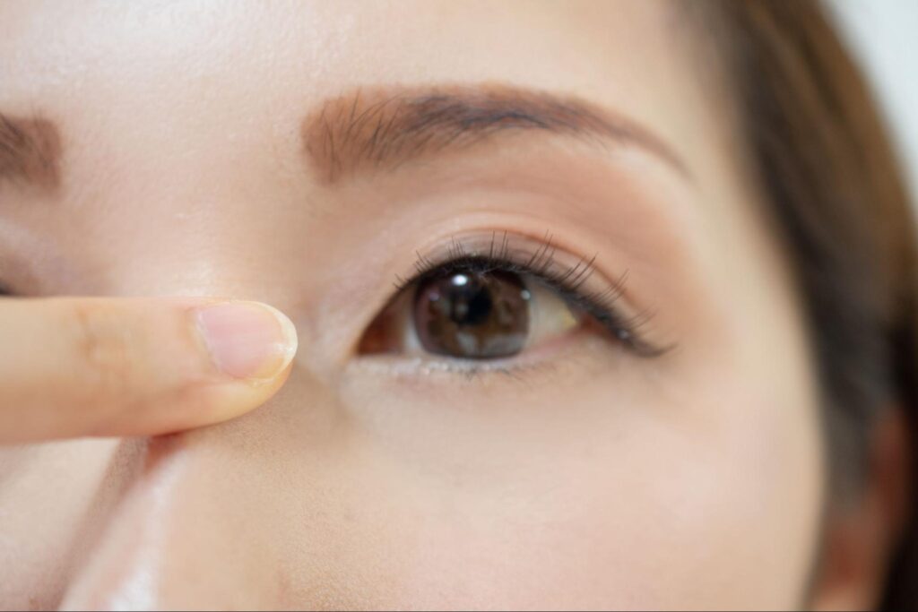 目頭切開(内眼角形成術)