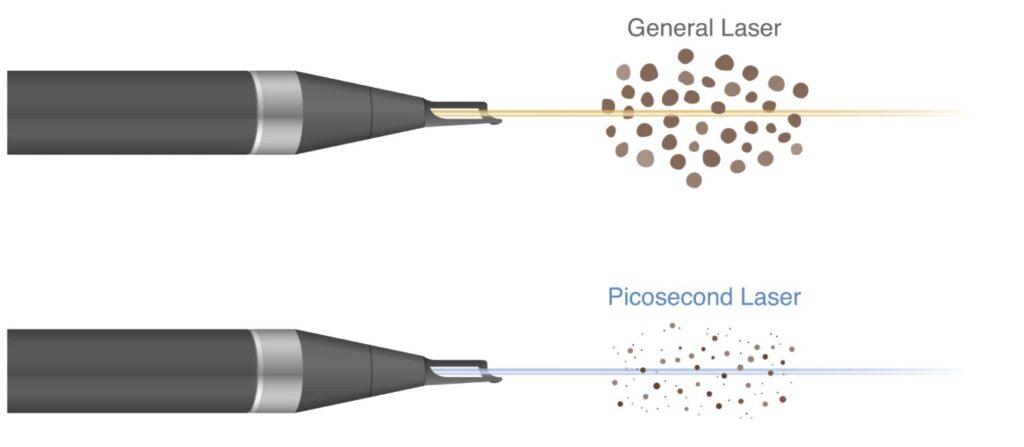 ピコレーザー(シミ治療)の特徴
