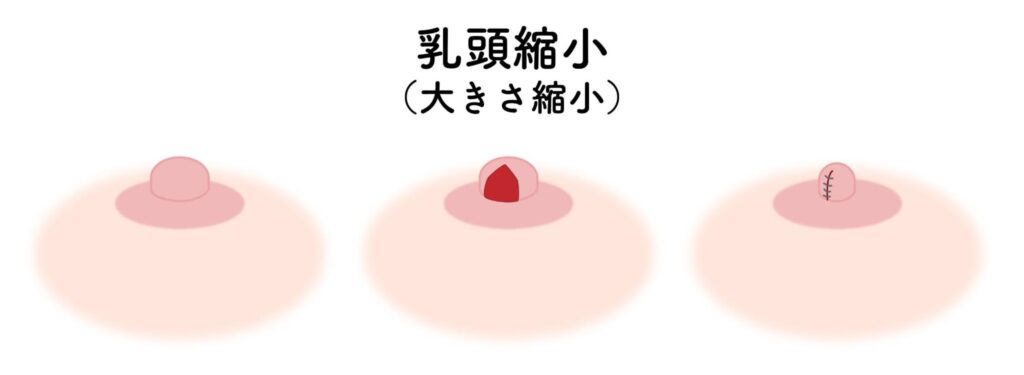 乳頭縮小術の特徴