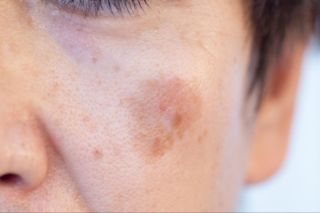 シミ できやすい人